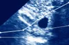 Ectopic Pregnancy Deaths Have Nearly Doubled. It’s Worse in States With Abortion Bans.