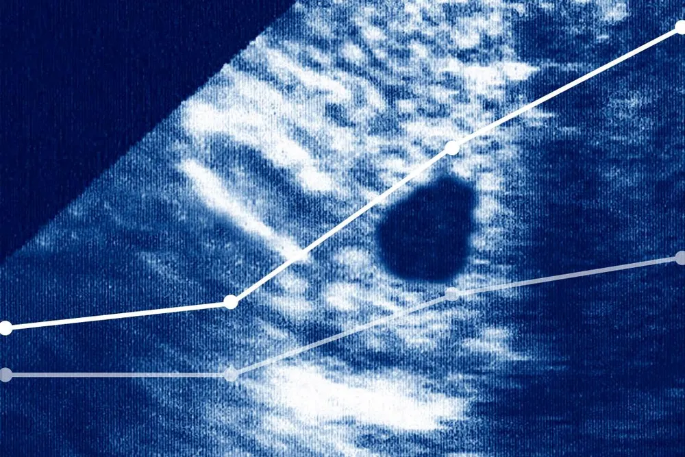 Ectopic Pregnancy Deaths Have Nearly Doubled. It’s Worse in States With Abortion Bans.